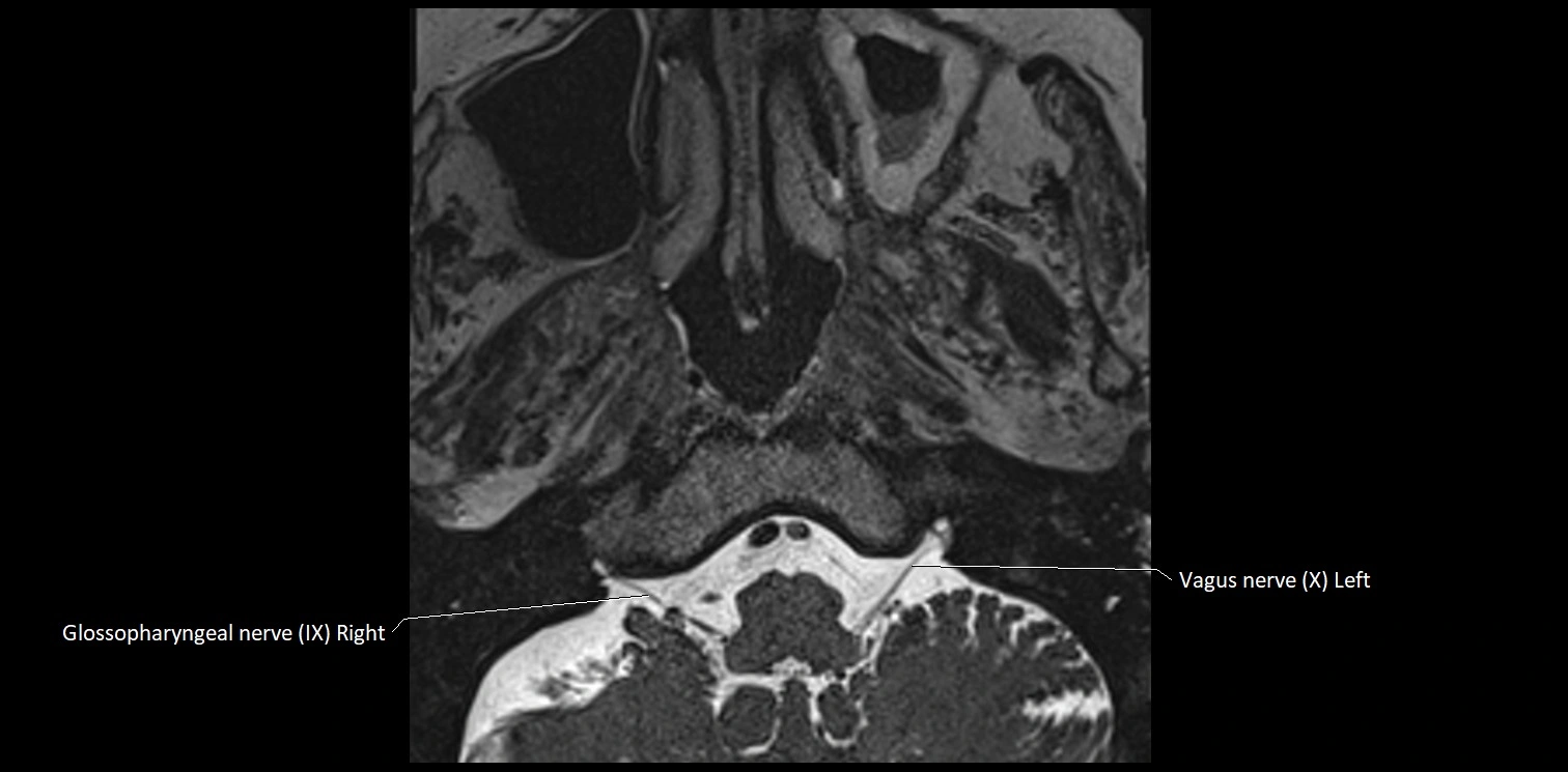Cranial nerve anatomy axial MRI 3T image 70.webp